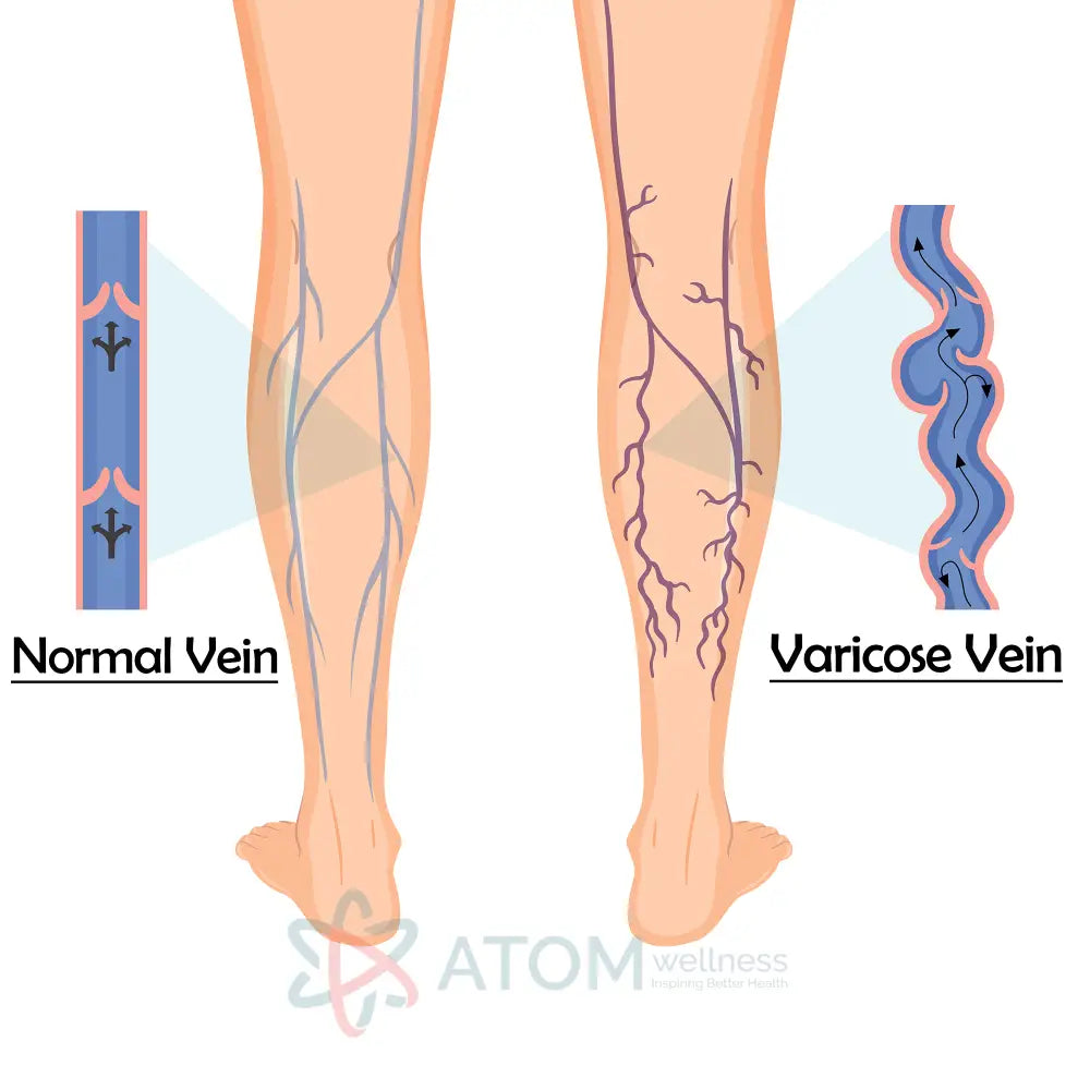 Varicose Vein Specialist Surgeon Tele-Consultation Tele Consultation