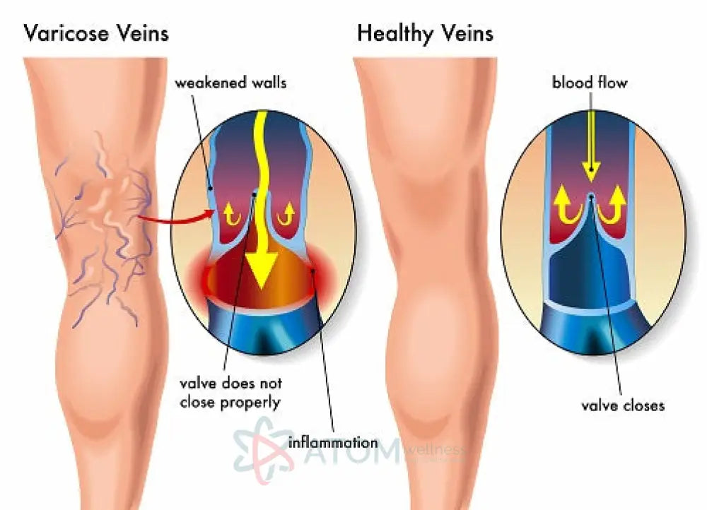 Varicose Vein Specialist Surgeon Tele-Consultation Tele Consultation