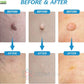 2 in 1 Skin Tag Remover Kit - Painless