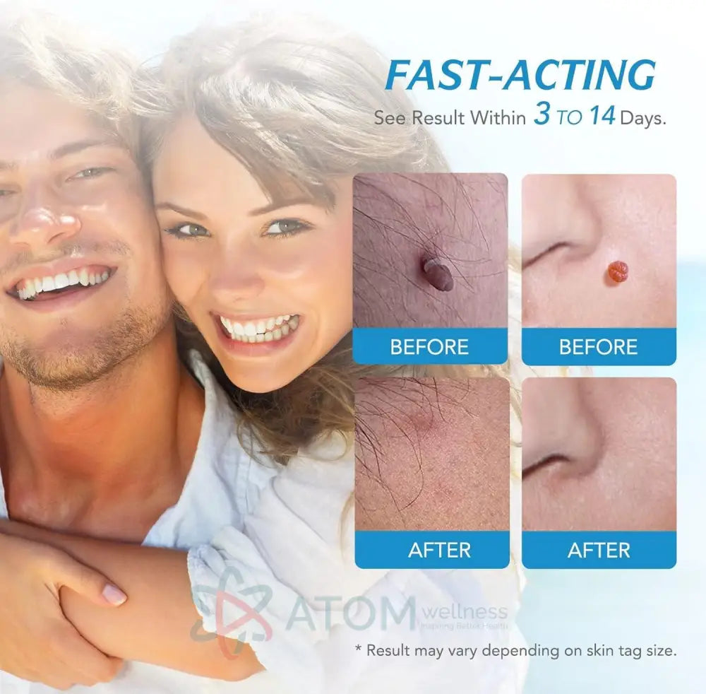 2 in 1 Skin Tag Remover Kit - Painless