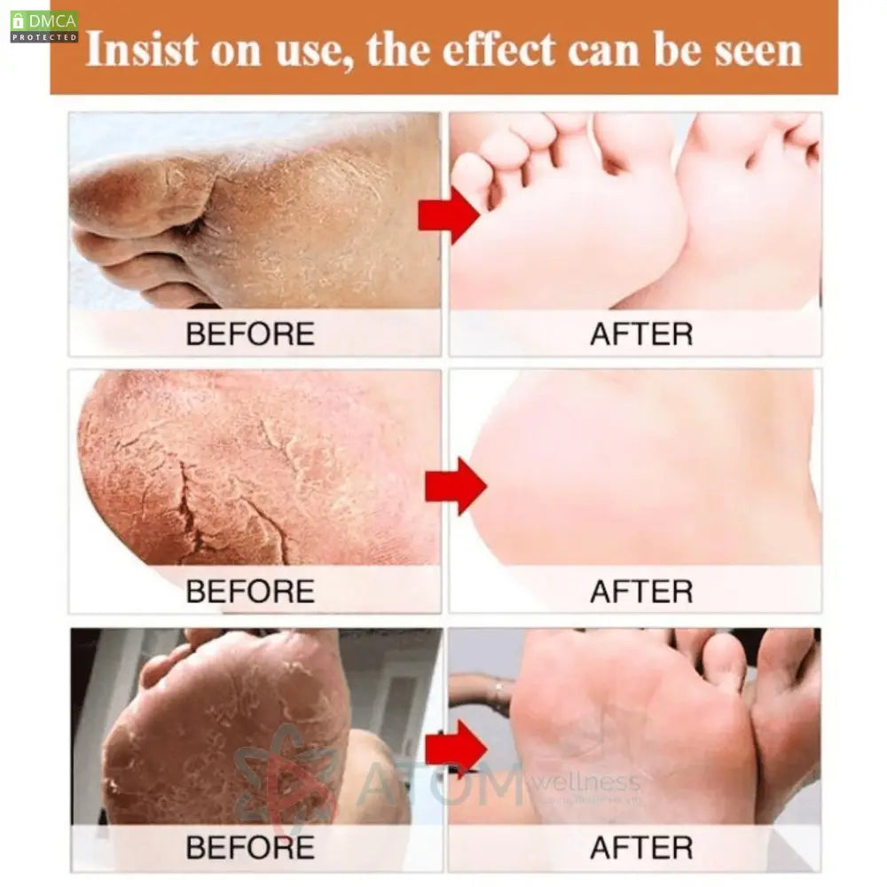 Foot Cream for Cracked and Dry Skin Heel Finger Healing Balm and Blaster 200 ml